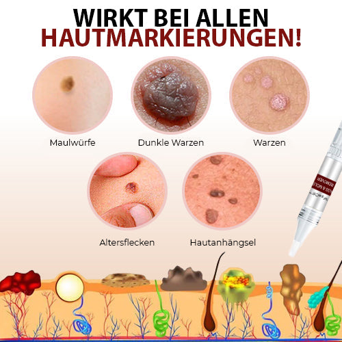 WipeOff Tags & Mole Remover - Effectieve oplossing voor een heldere, gladde huid