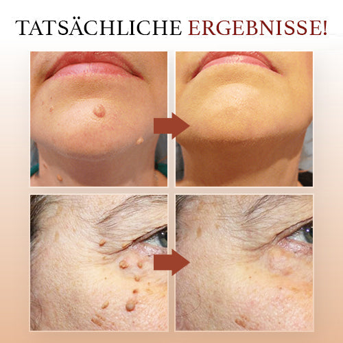 WipeOff Tags & Mole Remover - Effectieve oplossing voor een heldere, gladde huid